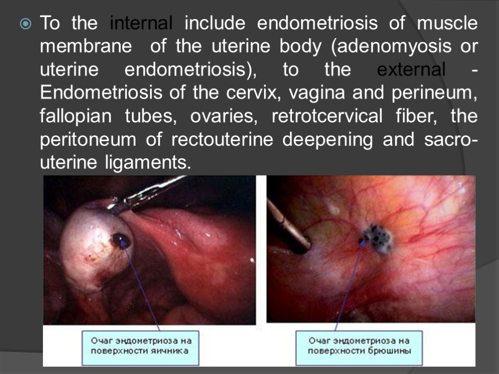 To the internal include endometriosis of muscle membrane of the uterine body (adenomyosis or